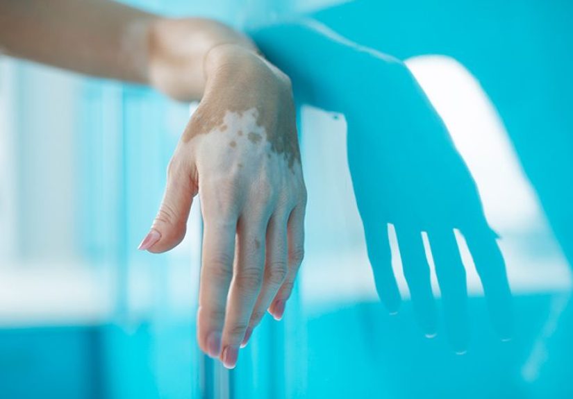 Excimer laser for vitiligo: Facts about this treatment and more