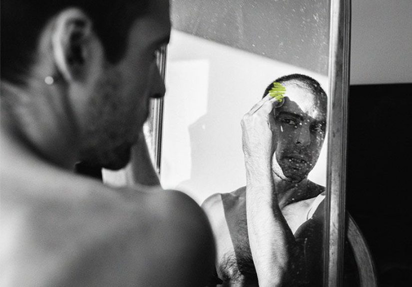 Male Pattern Baldness: Causes and Treatment