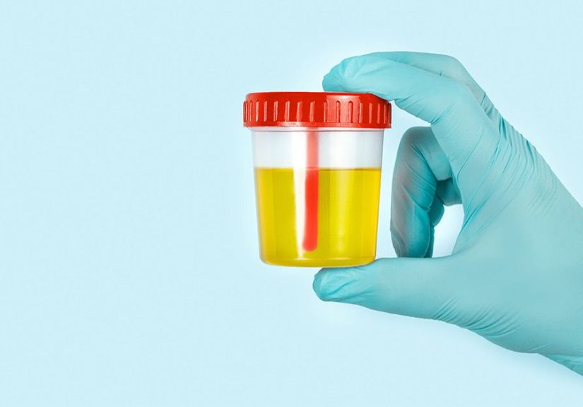 Prostate Cancer: New Urine Test May Help Reduce Unnecessary Biopsies