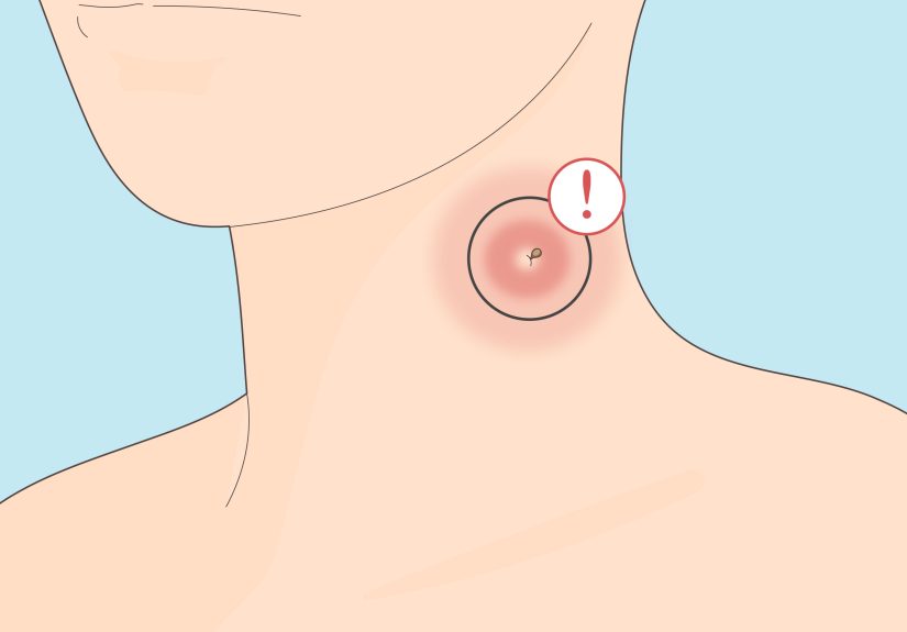 3 Ways to Treat a Wasp or Hornet Sting