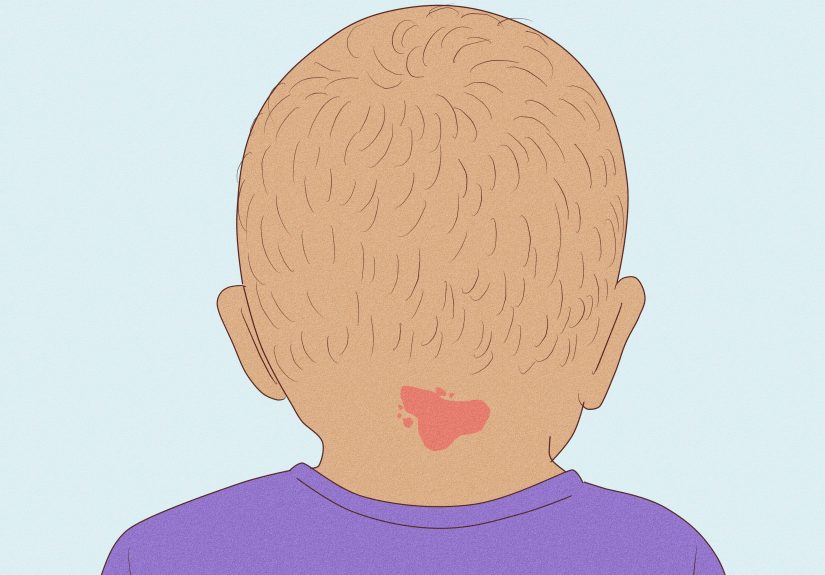 Angel Kiss Birthmark Meaning: Spiritual Interpretations