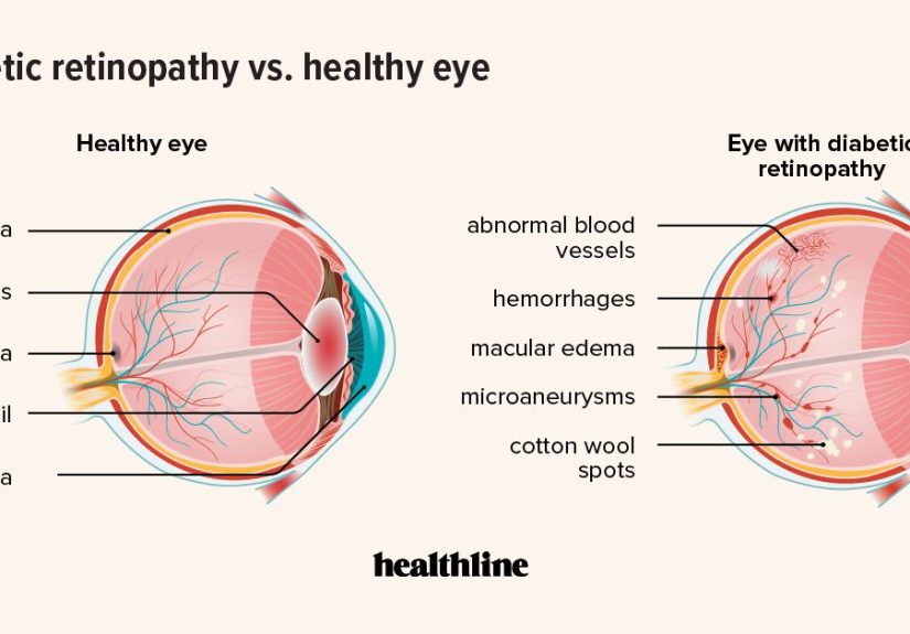 Changes in Your Eye with Diabetic Retinopathy