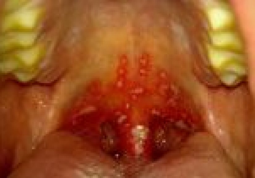 Gingivostomatitis: Causes, Symptoms, and Diagnosis