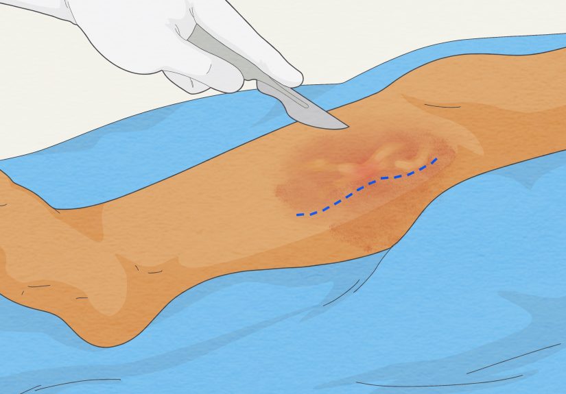 How to Detect a Blood Clot in the Leg: Signs & Symptoms