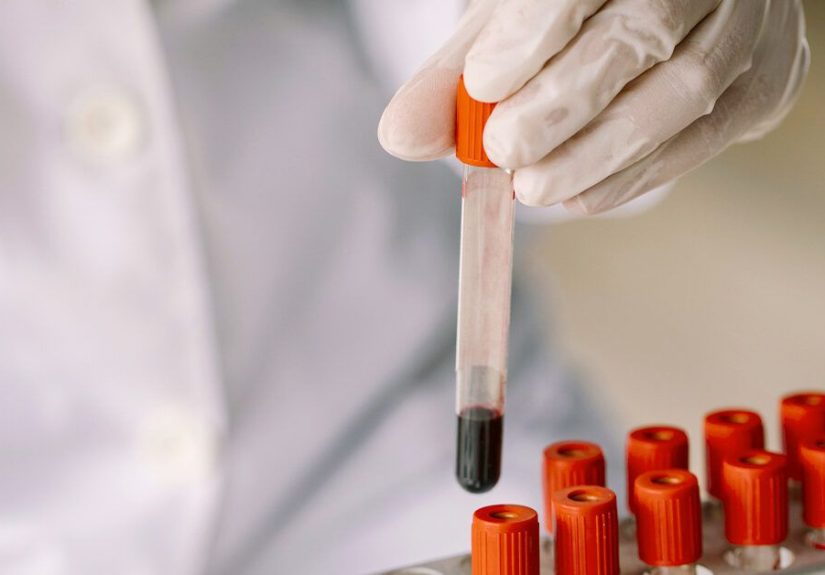 How to Diagnose Lupus: Tests, FAQs, and More