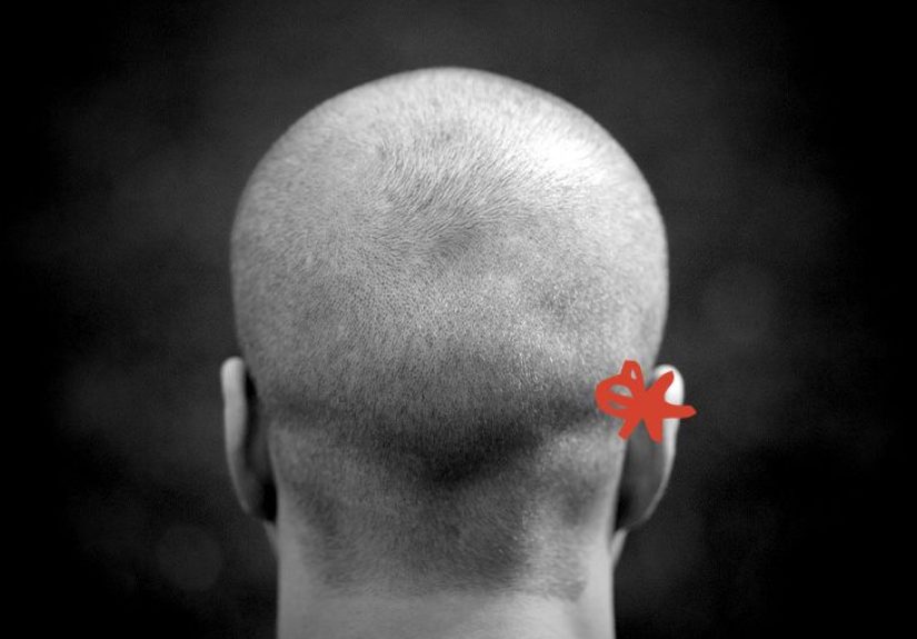 Lump Behind Ear: Causes, Diagnosis, and More