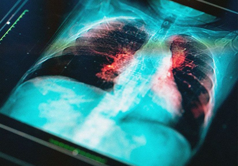 Lung cancer in nonsmokers: Causes, symptoms, treatment, and more