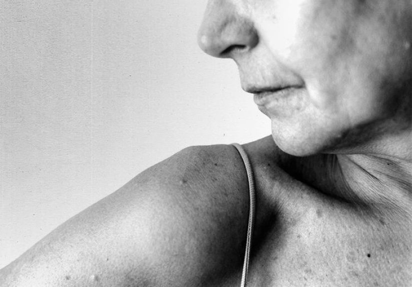 Neck lift surgery: What to expect, recovery time and risks