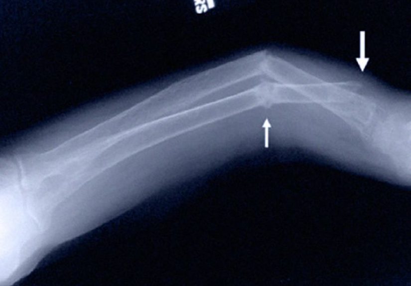 Osteomalacia: Causas, síntomas, tratamiento y más