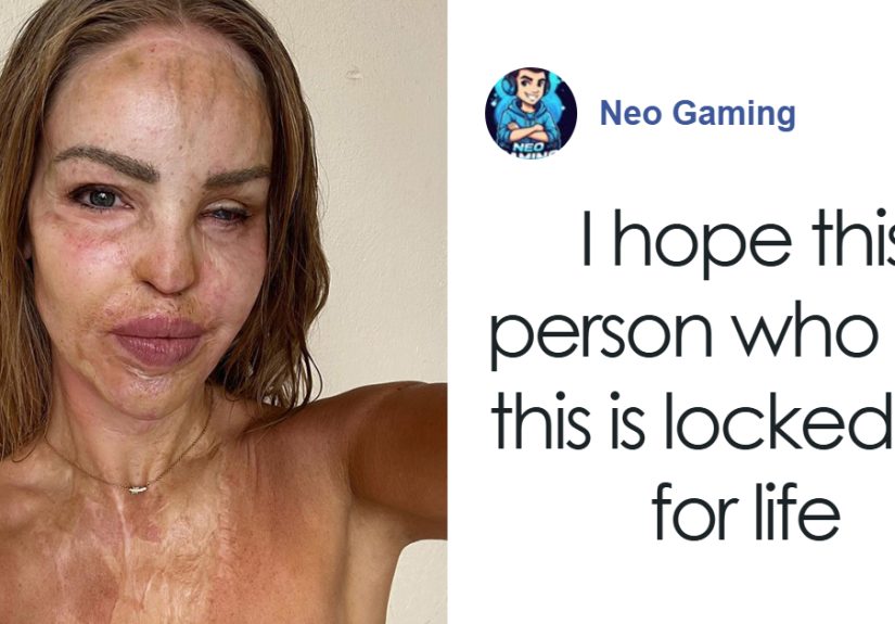 “So Cowardly”: Katie Piper Announces ‘End Of The Road’ Health Update 16 Years After Acid Attack