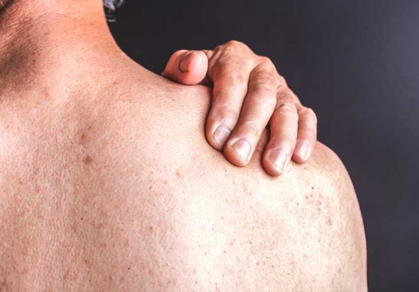 8 Types of Psoriasis: Photos, Symptoms, and More