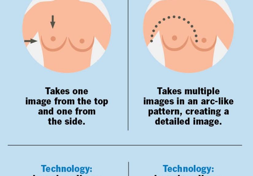 Breast Tomosynthesis