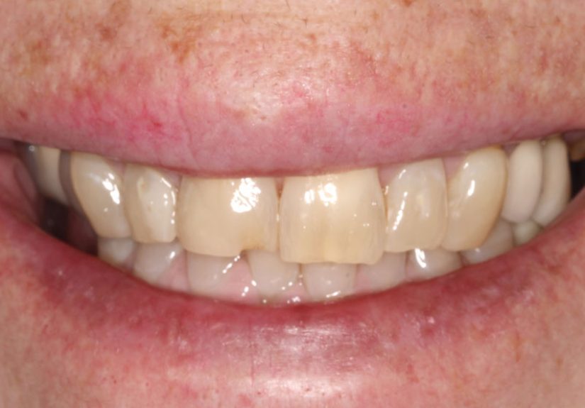 Chipped Tooth: Causes, Symptoms & Repair