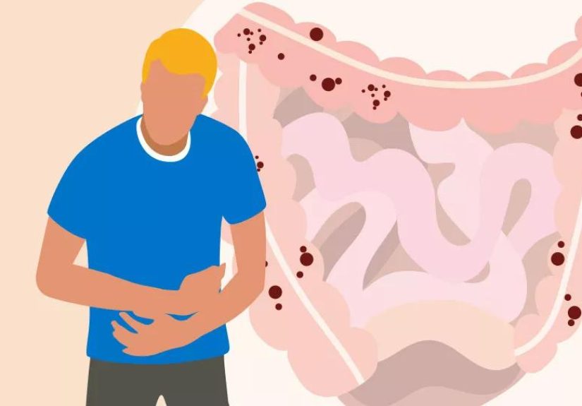 Creating a Crohn’s Disease and Colitis Diet Plan