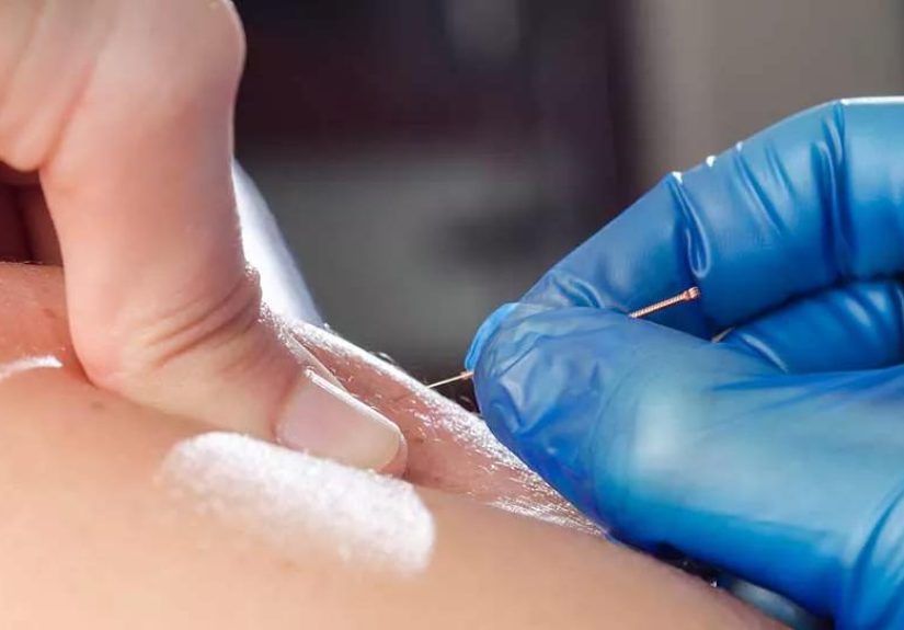 Dry Needle Therapy: How Does It Work?