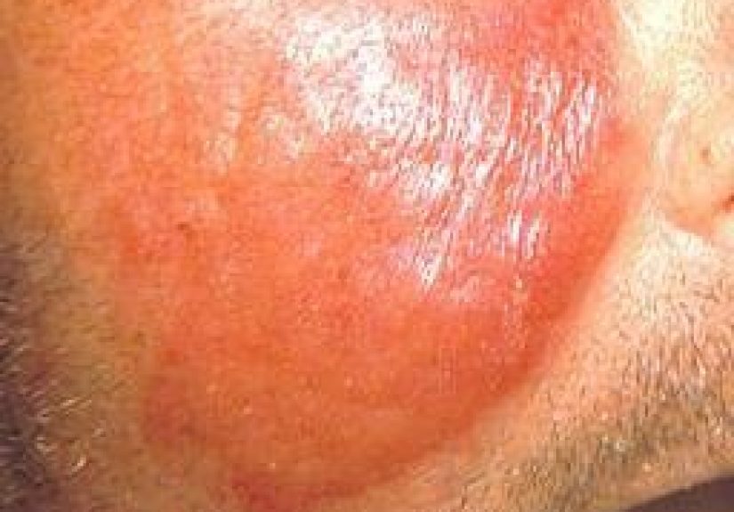 Erysipelas: Causes, symptoms, and treatment