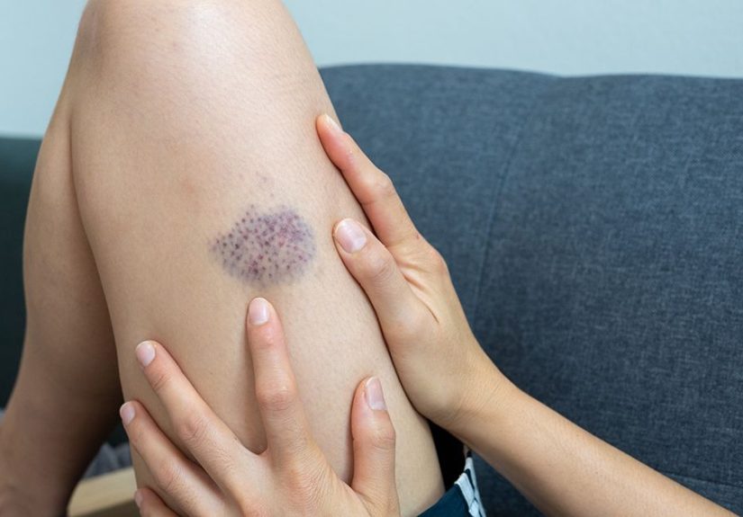 Hematoma vs. Bruise: What Is the Difference?