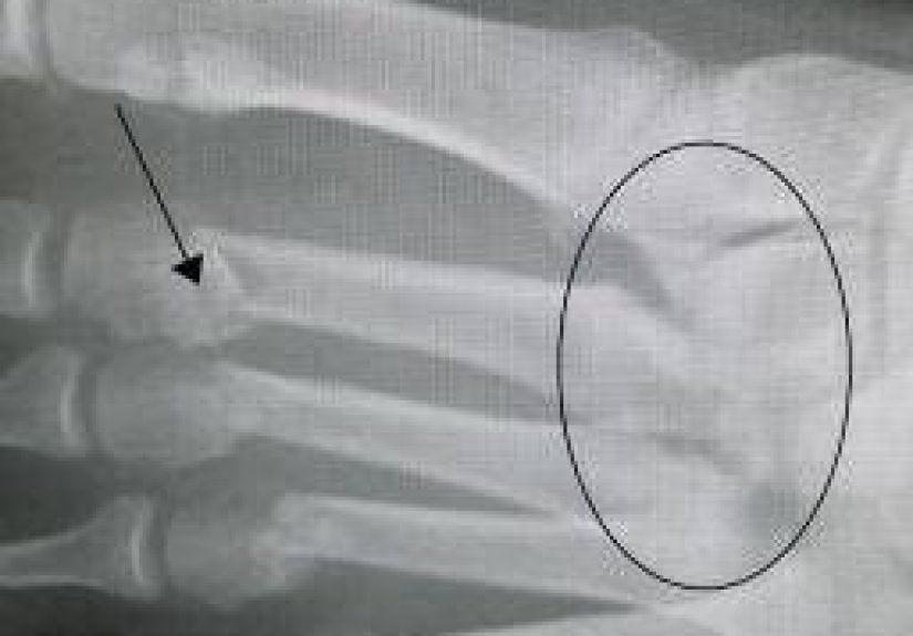 Lisfranc fracture: Causes, symptoms, and treatment