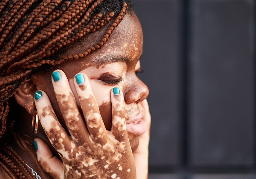Overcoming Vitiligo Stigma