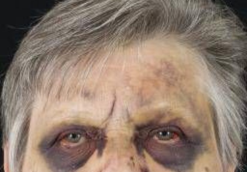 Raccoon Eyes: Causes and Treatments