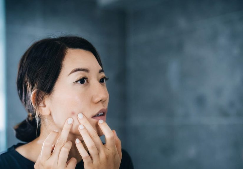 Scientists Say a New Vaccine Could Finally Cure Acne