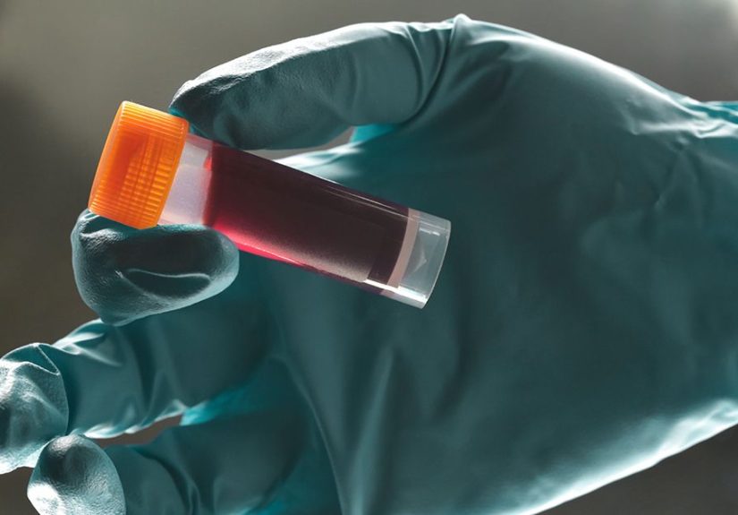 Stress and Positive ANA Result: Are They Related?
