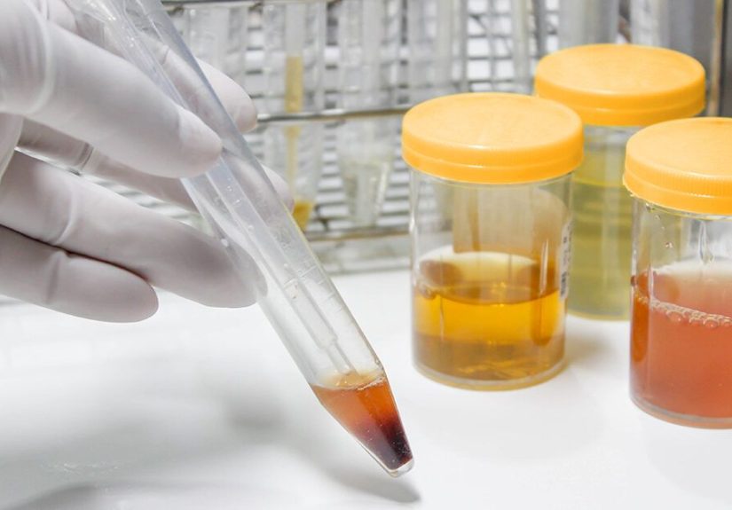 Urine Color in Kidney Failure: Changes to Watch For