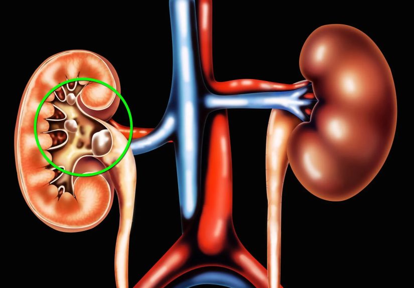 Where Stones Can Form in Your Body