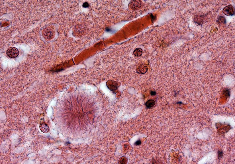 Creutzfeldt-Jakob Disease: Causes, Symptoms, Treatment