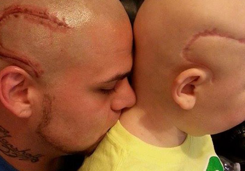 Dad Tattoos His Son’s Cancer Scar On His Own Head To Boost Son’s Self-Confidence