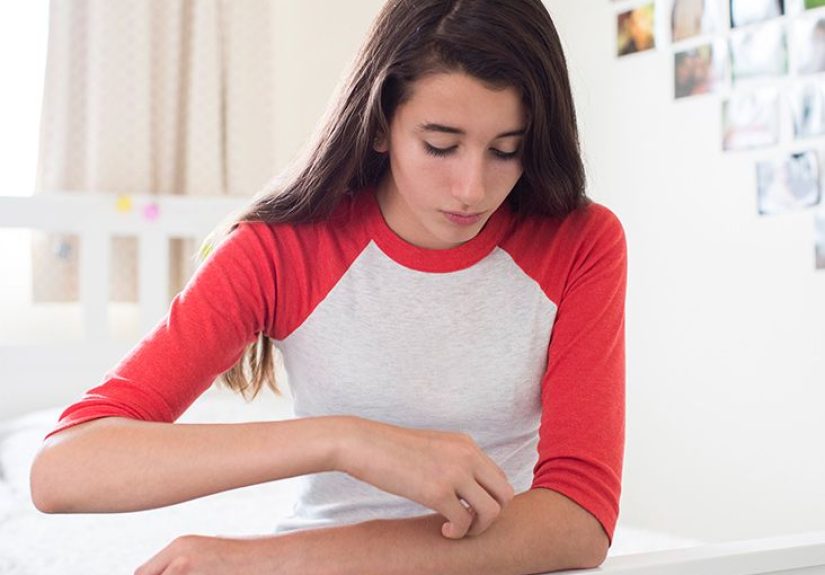 Home Remedies for Hives: Antihistamines, Oatmeal & More