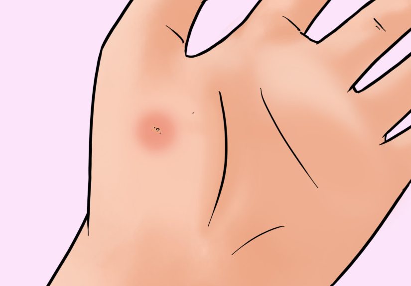 How to Remove a Pin or Tack from Your Skin: 10 Steps