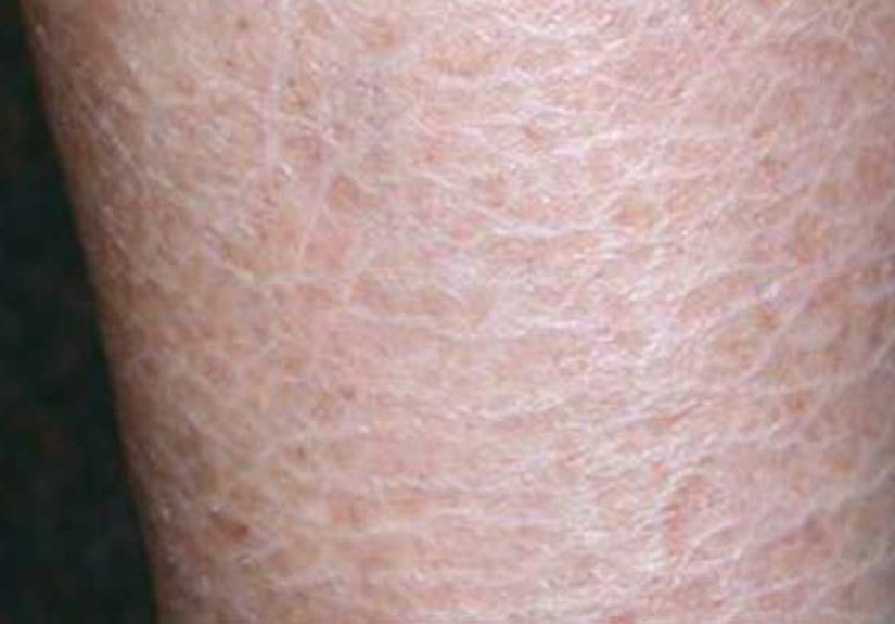 Ichthyosis Vulgaris: Causes, Symptoms, and Diagnosis