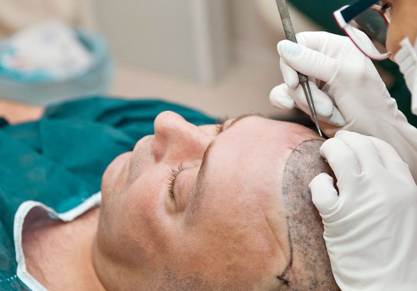 Is a Hair Transplant Permanent? What to Expect Long-Term