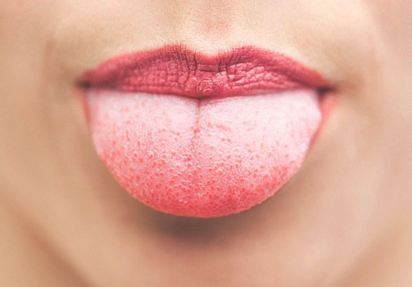Lie Bumps (Transient Lingual Papillitis)