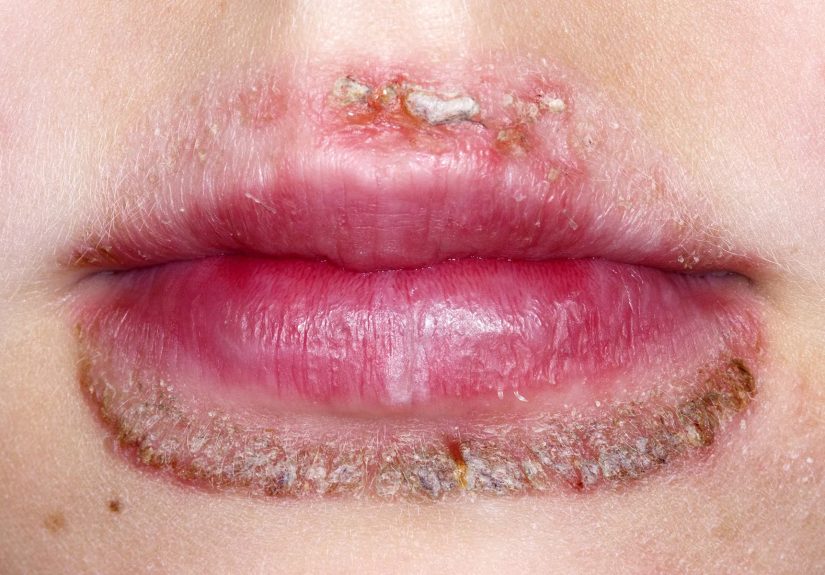Perioral Dermatitis: Causes, Symptoms, and Treatment