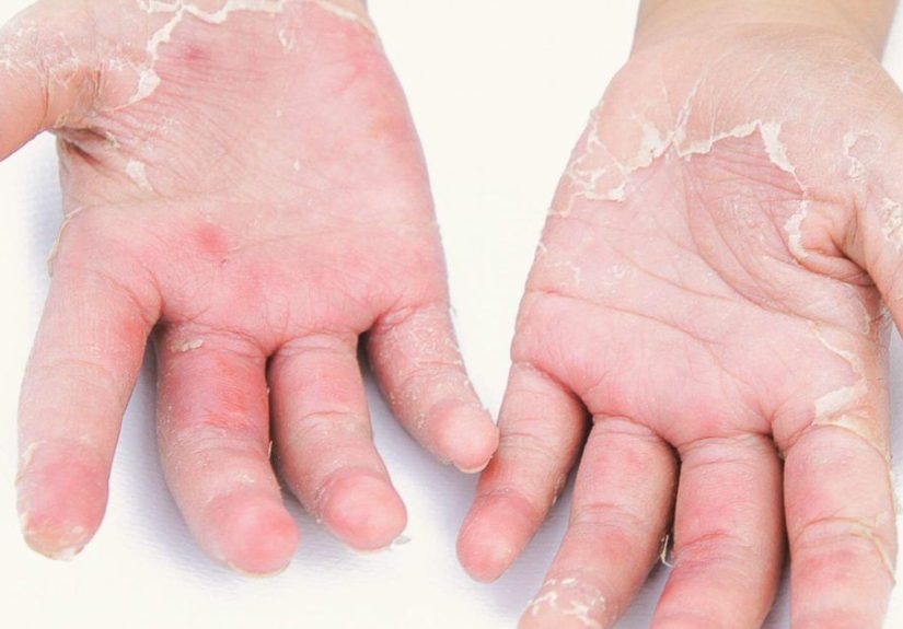 Psoriasis palmoplantar: Causas, síntomas y tratamiento