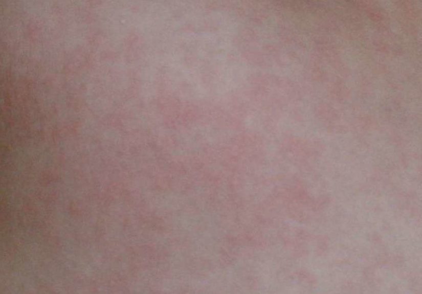 Roseola: Symptoms, Causes, and Treatment