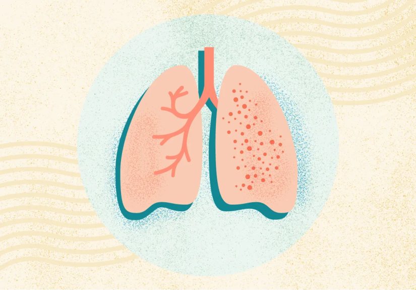 What Is Tuberculosis? Symptoms, Causes, Diagnosis, Treatment, and Prevention