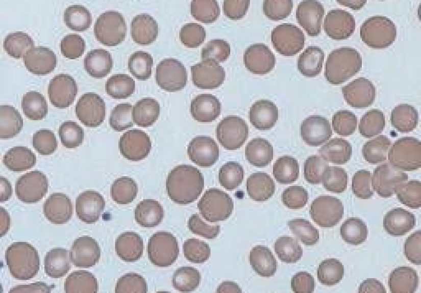 Anisocytosis: Causes, Symptoms, and Treatment