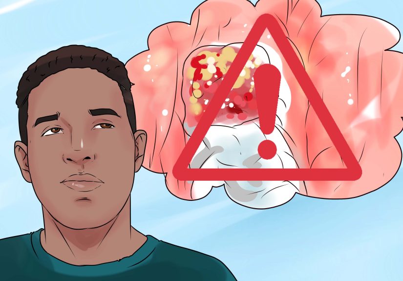 How to Remove Food from Extracted Wisdom Teeth Sockets: 14 Steps