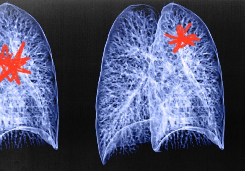 Lung cancer: AI tool Sybil may be able to predict risk within 6 years