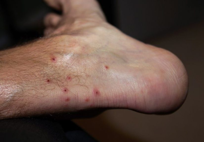 Mite bites: Symptoms, treatment, and different bites