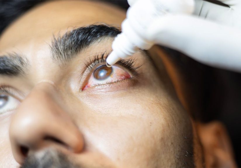 Pneumococcal conjunctivitis: Symptoms and how to treat them