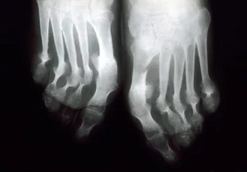 Psoriatic Arthritis Remission: Can Psoriatic Arthritis Go Away?