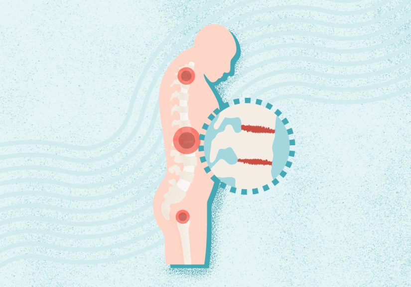 What Is Ankylosing Spondylitis? Symptoms, Causes, Diagnosis, and Treatment