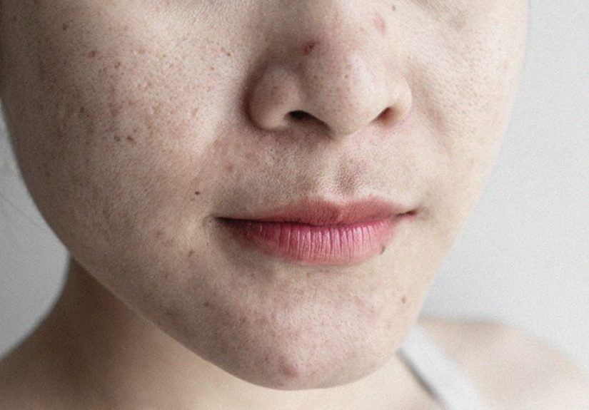 What is Sebum? Function, Production, Benefits, and More